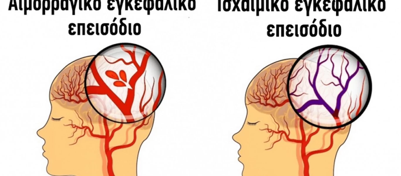 Δείτε τι πρέπει να κάνετε σε ένα εγκεφαλικό επεισόδιο - Τα τρία «βήματα»